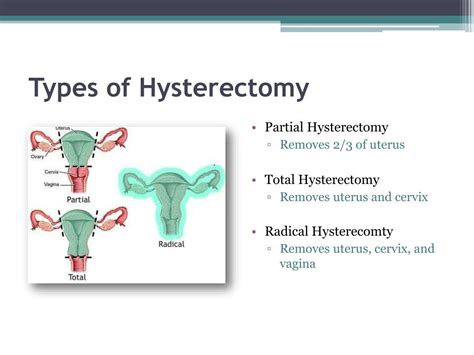 is hysterectomy considered as pwd in the philippines